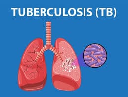Fight Against TB: Mpumalanga Department of Health Calls for Mass Screening Participation