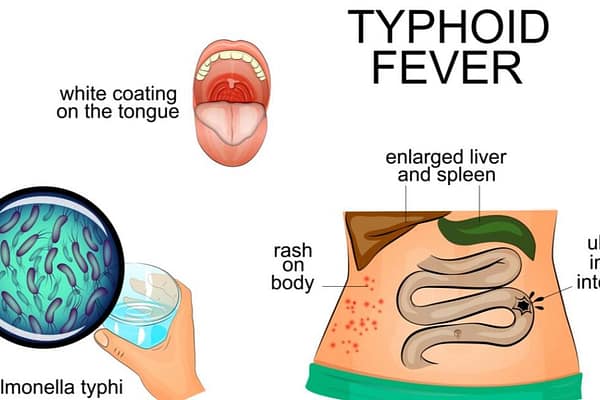 City of Tshwane Confirms Typhoid Cases in Hammanskraal and Bronkhorstspruit