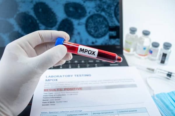 Gauteng Health Says Province Ready To Respond To Mpox Cases